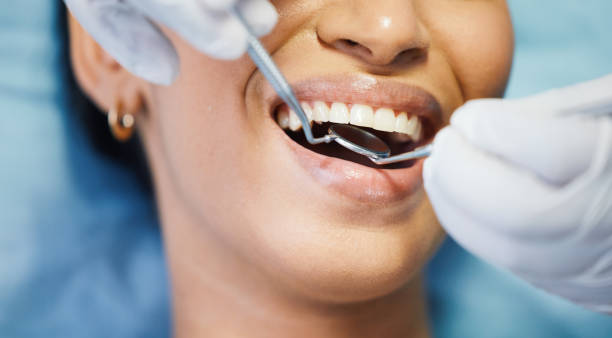 Best Knocked-Out Tooth (Avulsed Tooth) Treatment in Wharton, TX